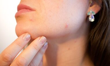 Skin tag removal