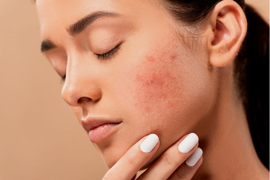 When to Seek Medical Help for Acne