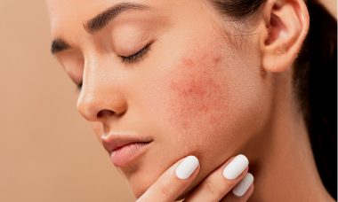 When to Seek Medical Help for Acne