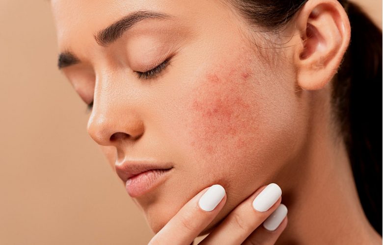 When to Seek Medical Help for Acne - Pink Is The New Blog