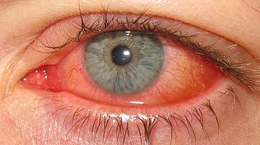 Ocular Rosacea