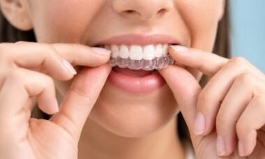 What To Know Before Starting Invisalign Treatment