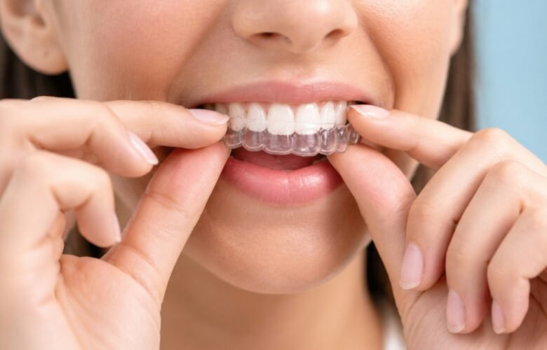 What To Know Before Starting Invisalign Treatment